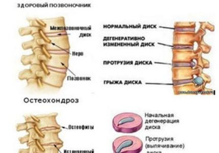Therapeutic exercises for osteochondrosis of the cervical spine: features and contraindications
